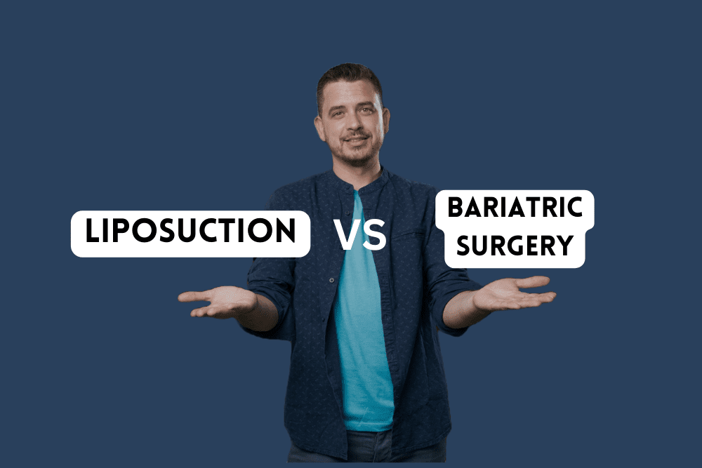 liposuction indore vs bariatric surgery, liposuction treatment in indore